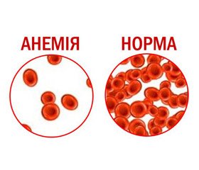 Проведення кесаревого розтину у пацієнтки з патологією системи згортання крові