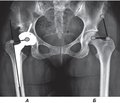 Подбор компонентов эндопротеза  и величина общего бедренного офсета  после эндопротезирования  тазобедренного сустава  (рентгенометрическое исследование)