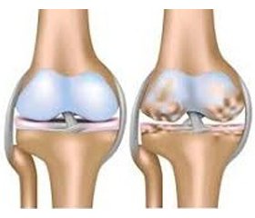 Сустамар: хондропротектор с противовоспалительными и анальгезирующими свойствами в терапии пациентов с остеоартрозом