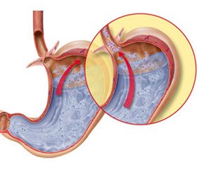Особенности клинического течения коморбидных гастроэзофагеальной рефлюксной болезни  и хронического гастродуоденита у детей