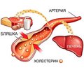 Обзор рекомендаций 2018 г. рабочей группы ACC/AHA по коррекции уровня холестерина в крови