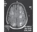 Синдром задней обратимой энцефалопатии (posterior reversible encephalopathy syndrome — PRES) в акушерстве