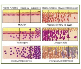 Хронический гастрит: континуум диагностики и лечения