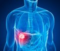 Increasing Efficacy of Treatment in Patients with Steatohepatitis