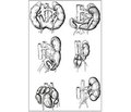 Врожденные аномалии взаиморасположения и поворота почек: частота, этиопатогенез, пренатальная диагностика, клиника, физическое развитие, диагностика, лечение и профилактика