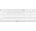 Діагностика й особливості лікування пейсмейкерної тахікардії