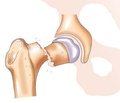 Study indicators of bone metabolism in patients with diabetes mellitus type 2 with trochanteric area fractures