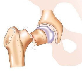 Study indicators of bone metabolism in patients with diabetes mellitus type 2 with trochanteric area fractures