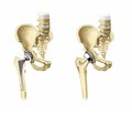 Arthroplasty of the proximal femur for bone tumors