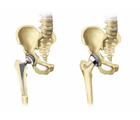 Arthroplasty of the proximal femur for bone tumors