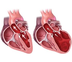 Сердечная недостаточность с сохраненной фракцией выброса левого желудочка