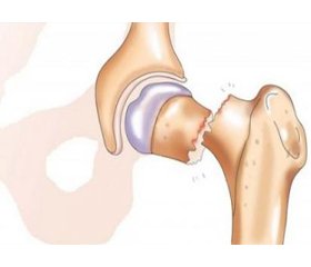 Endocrine osteoporosis