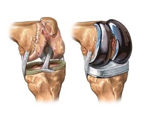 Indications and Contraindications for Arthroplasty of Tumor Defects of the Knee Joint Bones