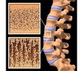 Using of Lovastatin Nanoparticles for the Osteoporosis Treatment and Fracture Risk Reduction (Experimental Study)