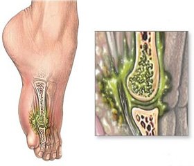 Current approaches to the treatment of chronic osteomyelitis of the lower limbs