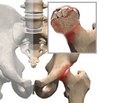 Aseptic Necrosis of the Femoral Head as a Possible Consequence of Hodgkin Lymphoma Chemotherapy