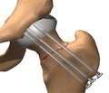 Experimental Study of Osteosynthesis Types in Midclavicular Fractures