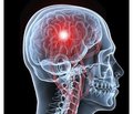 Conduction of infusion therapy in patients with acute stroke. Medical case