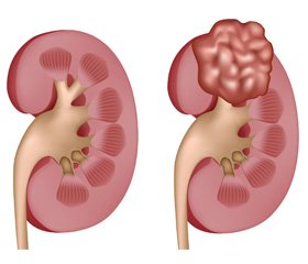 Етіопатогенез нирково-клітинного раку