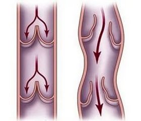 Патогенетическое лечение варикозной болезни