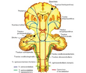 Case analysis of crossed cerebellar hemispheric diaschisis in acute stroke patients