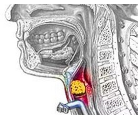 Неотложная помощь при обтурационной асфиксии (клиническая лекция)