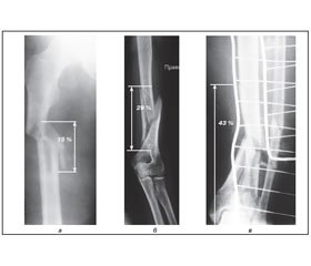 Оскольчатые диафизарные переломы и их лечение