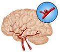 Influence of Artificial Therapeutic Hypothermia on Treatment Outcomes in Patients with Complicated Intracranial Aneurysmal Hemorrhages