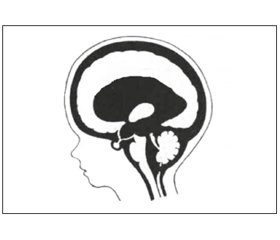 К вопросу дифференциальной диагностики, классификации и дифференцированного лечения гидроцефалии и гидроцефальных синдромов у детей