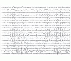 Особенности изменений ЭЭГ у детей с фармакорезистентными формами эпилепсий
