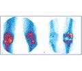Роль остеосцинтиграфії в програмі обов’язкового діагностичного скринінгу при ендопротезуванні колінних суглобів