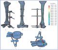 Анализ напряженно-деформированного состояния дистального отдела голени и стопы при повреждениях pilon в условиях наружной фиксации при помощи стержневых аппаратов