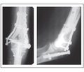 Клінічні результати лікування переломів ліктьового відростка за методикою інтрамедулярного блокованого металоостеосинтезу