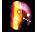 Клінічні випадки токсичного ураження очей на фоні застосування антиаритмічного препарату аміодарон